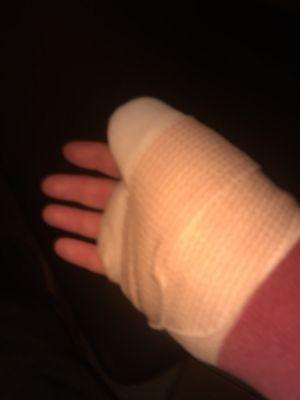 My broken hand.