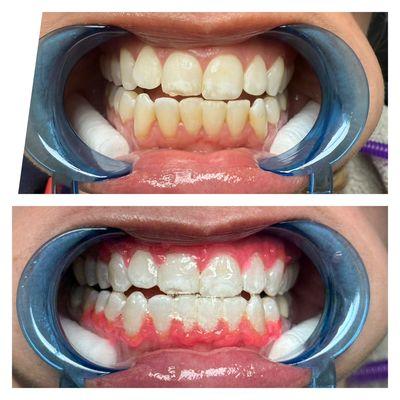 Teeth Whitening level 3 teeth whitening service is one hour here