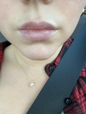 Versa+ lip filler