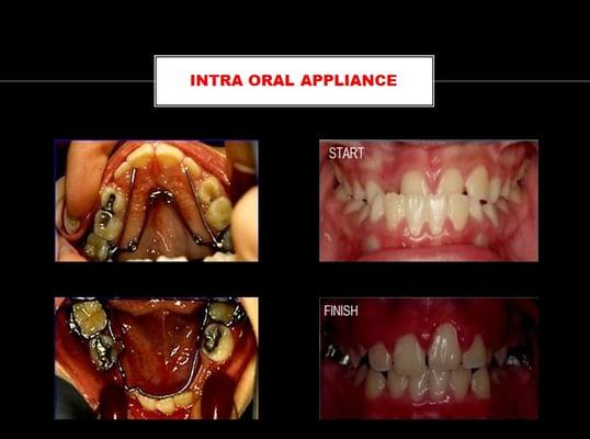 CASE 761: Anterior cross bite