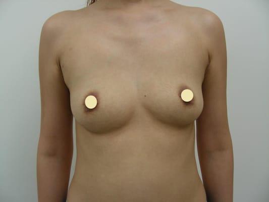 Patient has asymmetric breasts.