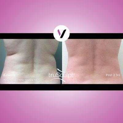 TruSculpt ID treats stubborn fat areas!