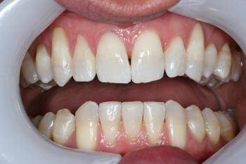 Tooth whitening
(after)