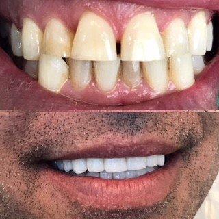 Dr. Kelly changed this mans life by creating this beautiful smile for him.