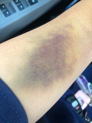 Left Arm - there are still bruises with pain