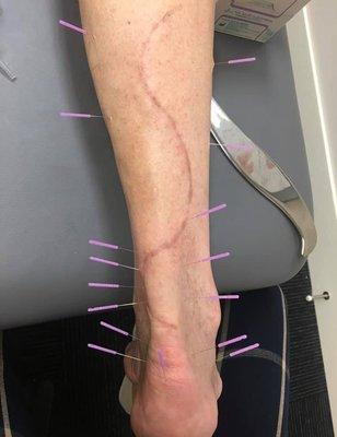 Dry needling