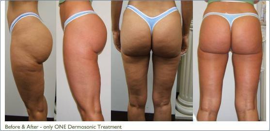 Dermosonic Cellulite Treatment (Slimming + Body Sculpting)