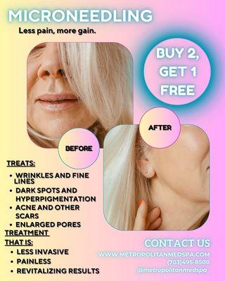 RF Microneedling, buy 2, get 1 free