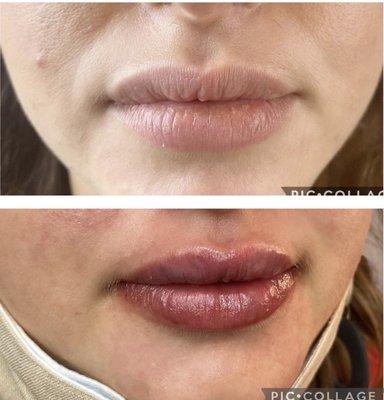 Lip fillers