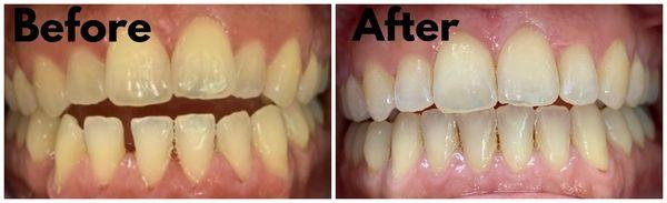 Before and after Invisalign treatment for teeth straightening.