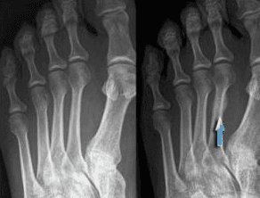 2nd metatarsal stress fracture.