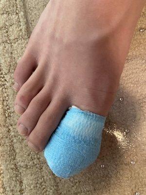 My son's toe after the ingrown nail removal .  Nicely wrapped and painless .