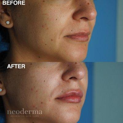 Lip enhancement by Neoderma. Ask our master injectors about lip dermal filler treatment for a fuller, natural look.