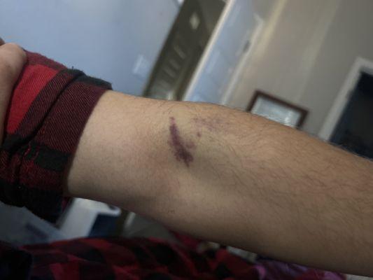 Bruise from going through the vein