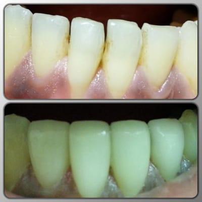 lower veneers