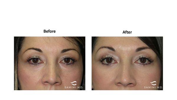 Female patient bothered by under eye bags, treated with lower blepharoplasty.