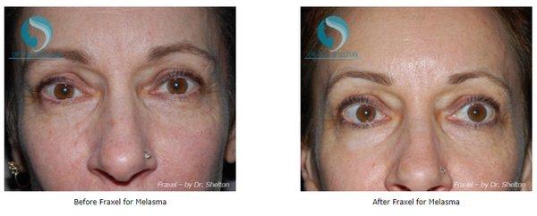 Treatment for Melasma...Before and after pics