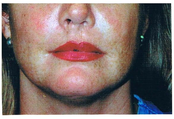 cleft after coloration corrective work