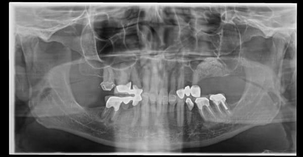 post op of the same patient with sinus graft. Next step Implants