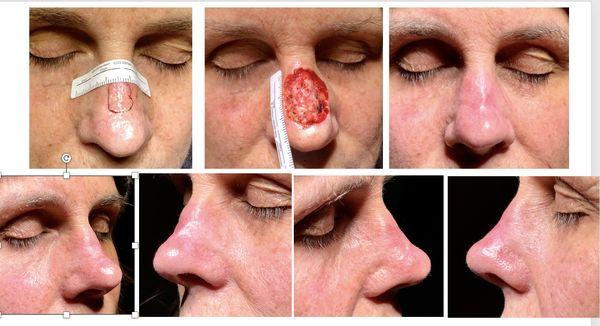 Before (upper left), after Mohs (upper middle) and healed (upper right and lower row) of a recurrent skin cancer - a Mohs success story!