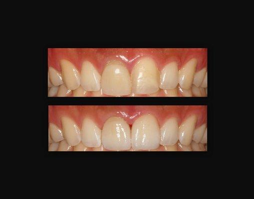 2 veneers