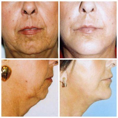 55-64 year old woman treated with Chin Implant, Face Lift and Neck Lift