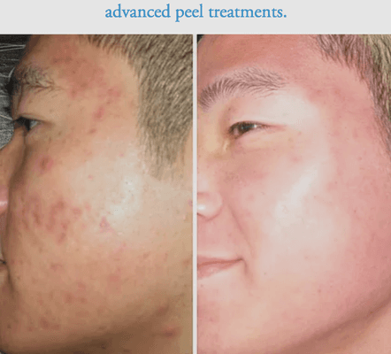 Advanced acne peel treatment