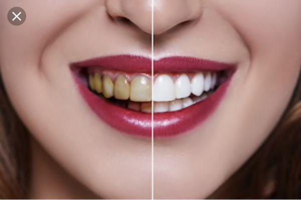 Whiten your teeth- Love your smile!