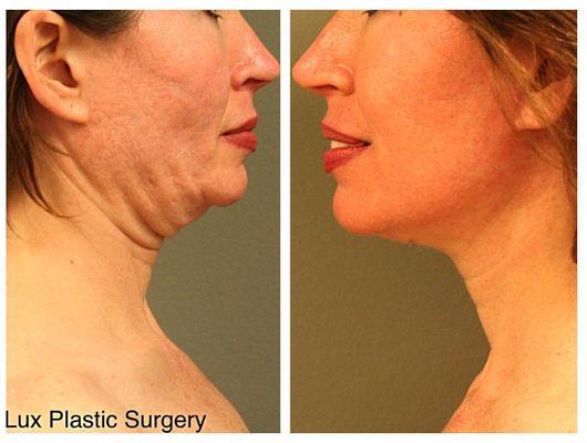 A neck lift can give you a more youthful and defined look.  Schedule a consultation today and get the look you want!