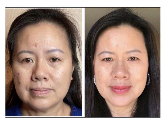 Non-surgical facelift and lip filler