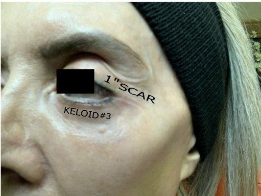 Scar & Keloid