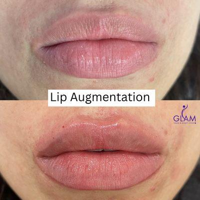 Lip Augmentation