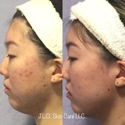 Acne clearance in 90 days