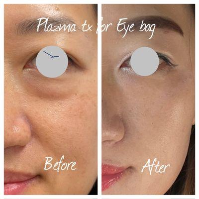 Plazma laser for eye bag treatment