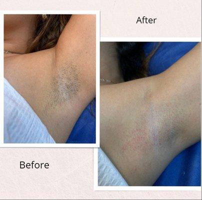 A flawless underarm wax by Camila!