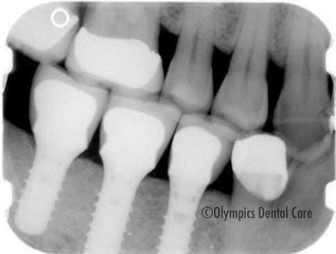 Implants to restore our patient's mastication (chewing/bite).  Dentist here in our San Leandro office can make that happen.