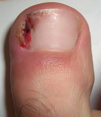 We treat ingrown toenail1