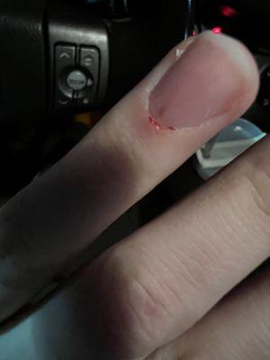 Right after finger was cut