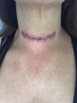 Neck incision-3 days post-op