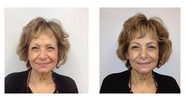 Before & After, Eyebrow Procedure. Results will appear softer, lighter and more natural looking in about a week.