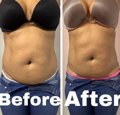 Progress photos of laser Lipo + Lipo Cavitation