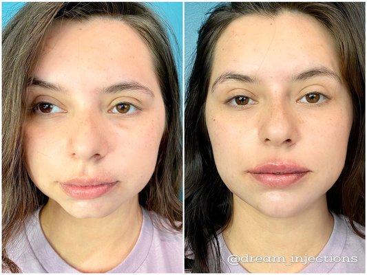 Facial harmonization with dermal filler. Nose, chin and jawline contouring