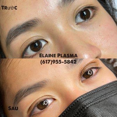 Correct upper eyelid by plasma pen fibroblast