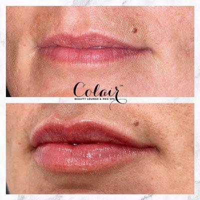 Lip Filler @ Colair Beauty Lounge & Med Spa