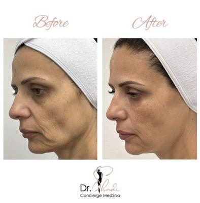 Sculptra and Skin Boosters for volume enhancement.