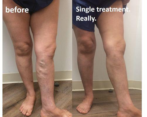 varicose vein removal