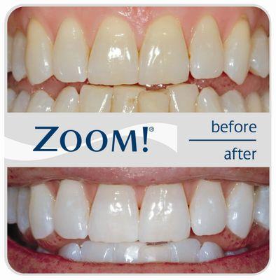 In Office Whitening!  Your smile can change  4-6 shades in 1 visit!