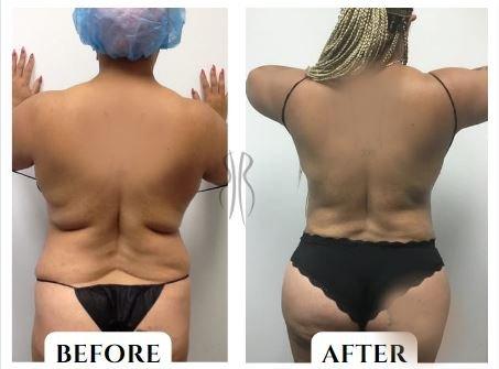 Before & After: Lipo of braline and waist. Fat transfer to hips and buttocks (BBL)