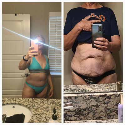 Photo in the right is before my panniculectomy.  Photo on the left is me today!!!