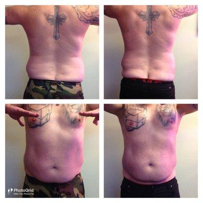 Emerald Laser Lipo (4 Sessions)